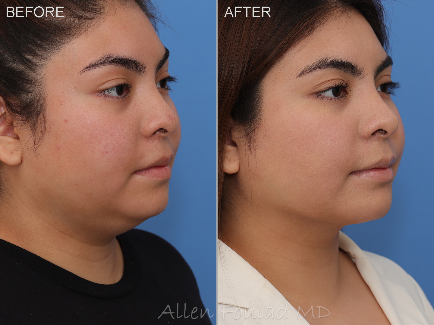 Face & Neck Liposuction Before and After Photo by Allen Foulad MD in Beverly Hills, CA