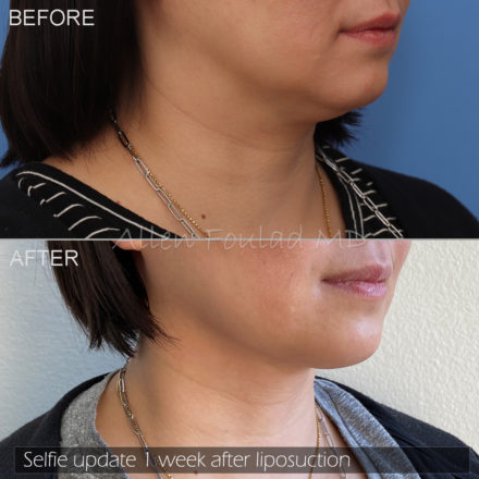 Neck (chin) and jowl liposuction before and after of woman 1 week after the procedure.