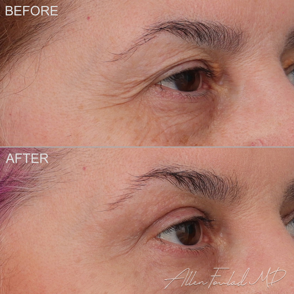 Before & After Upper Eyelid Blepharoplasty