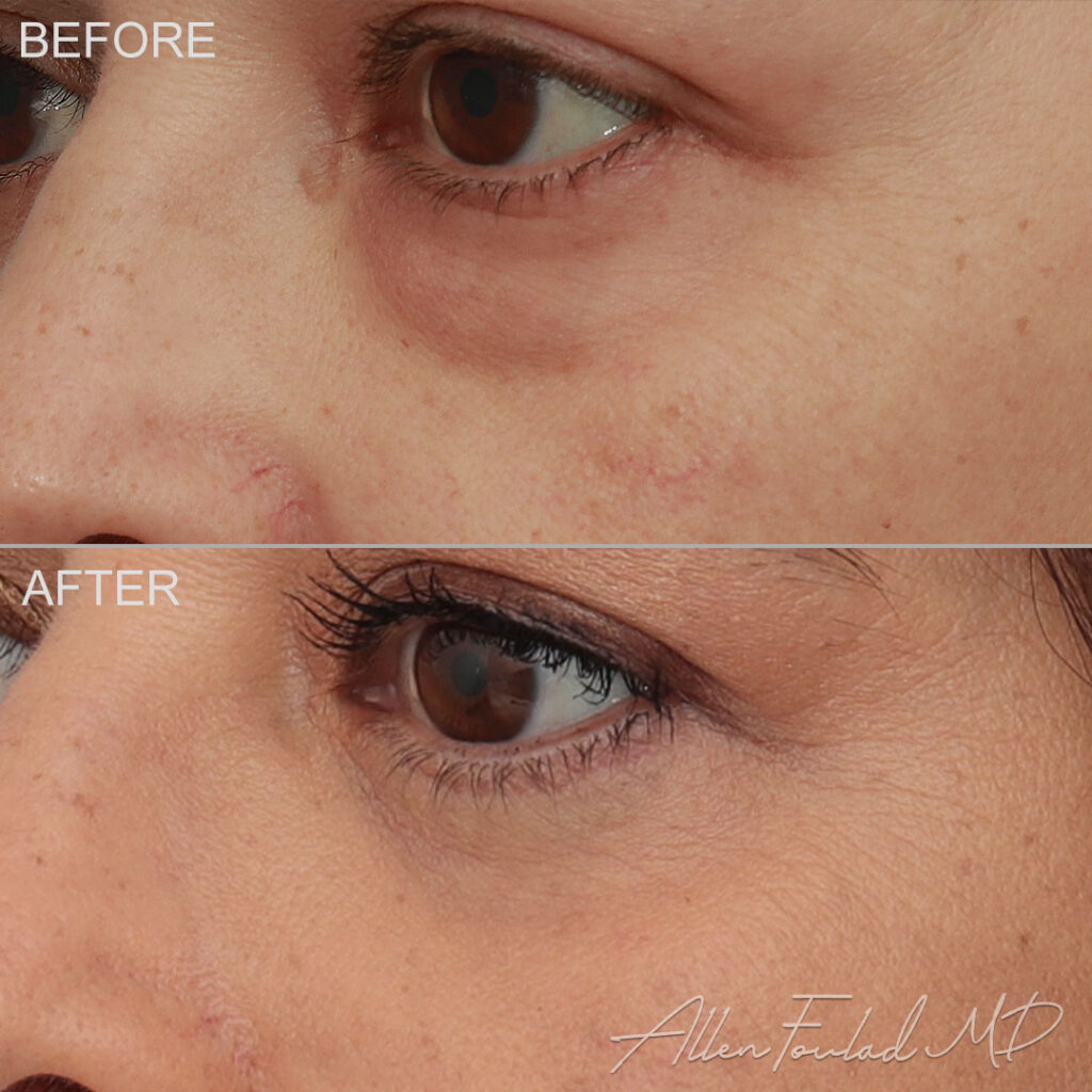 Before & After (id-1041) – Lower Eyelid Surgery Before and after Lower Eyelid Surgery, on patient.