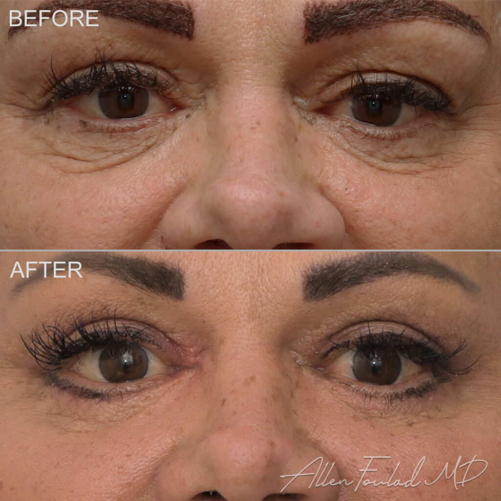 Before and after Lower Eyelid Surgery, on patient.