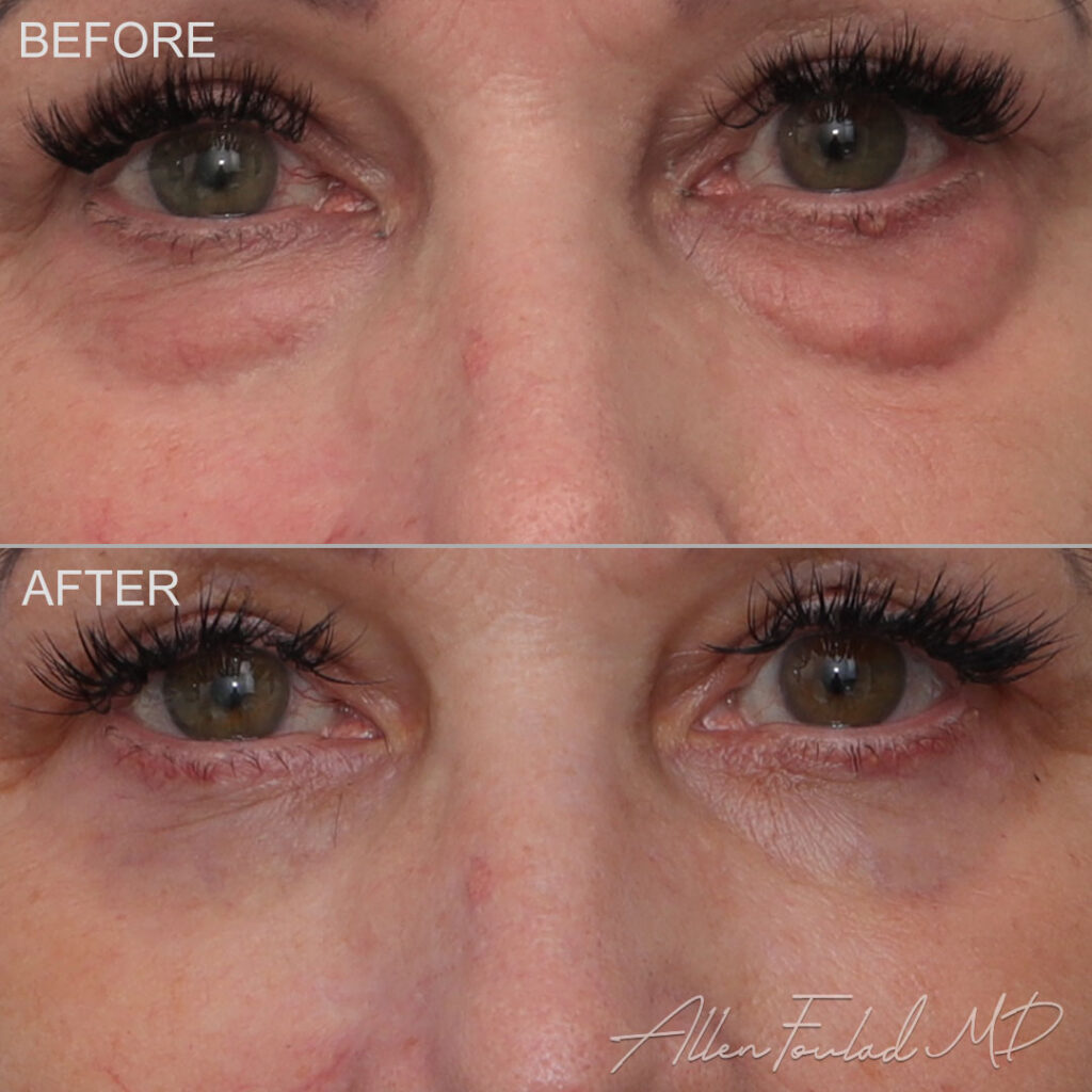 Before & After (id-1043) – Lower Eyelid Surgery Before and after Lower Eyelid Surgery, on patient.