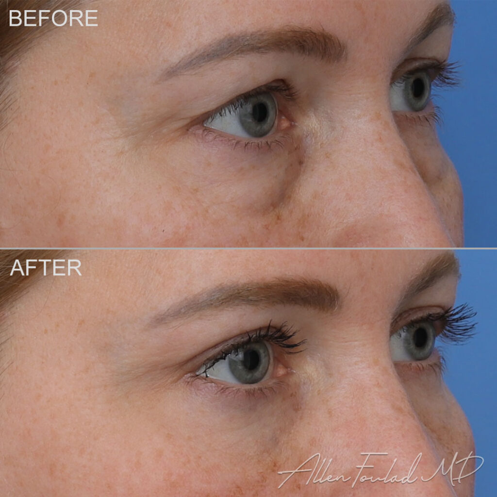 Before and after Lower Eyelid Surgery, on patient.