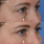 Before & After (id-1045) - Lower Eyelid Surgery