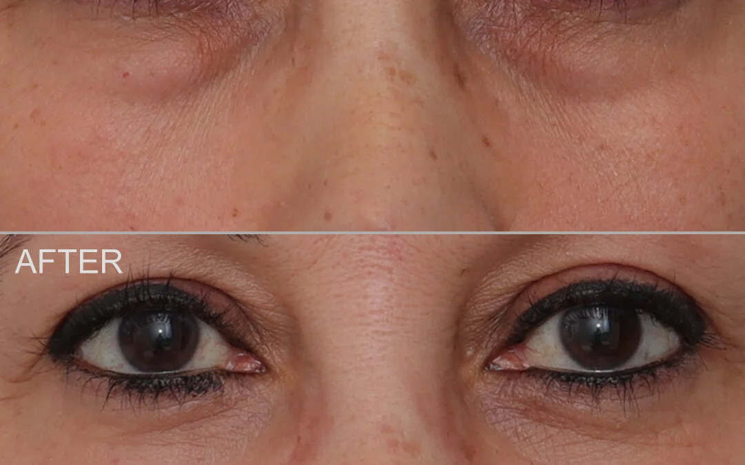 Before and after Lower Eyelid Surgery, on patient.