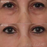 Before & After (id-1046) - Lower Eyelid Surgery