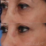Before & After (id-1046) - Lower Eyelid Surgery