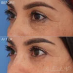 Before & After (id-1047) - Lower Eyelid Surgery