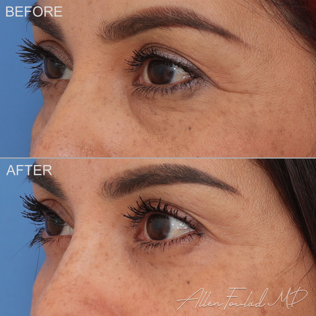 Before and after Lower Eyelid Surgery, on patient.