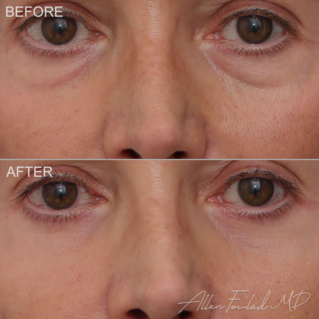 Before and after Lower Eyelid Surgery, on patient.