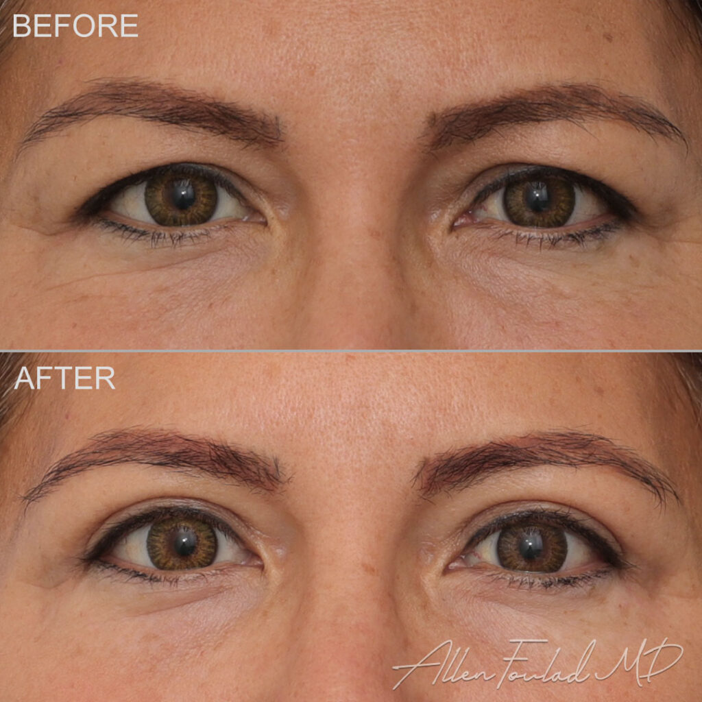 Before and after Upper Eyelid Surgery, on female patient.