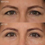 Before & After (id-1038) – Upper Eyelid Surgery