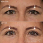 Before & After (id-1038) – Upper Eyelid Surgery
