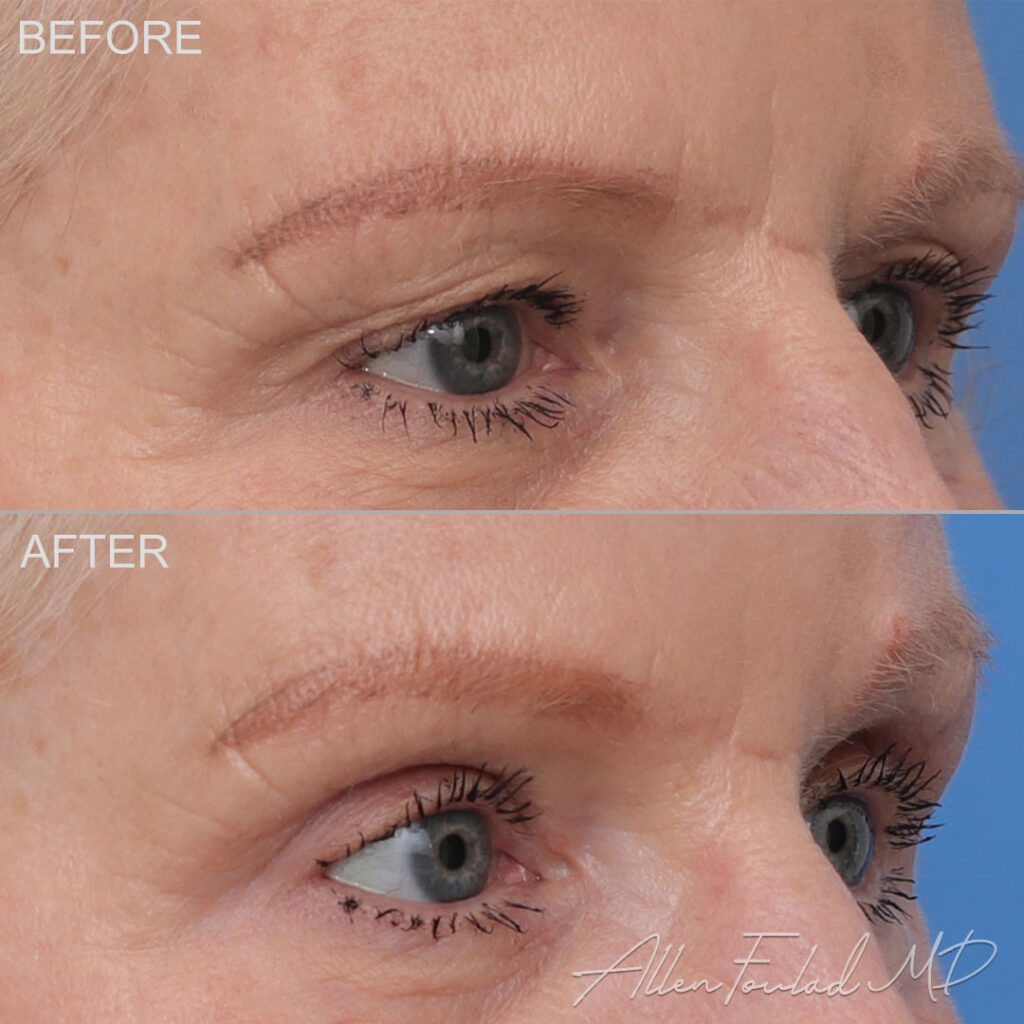 Before and after Upper Eyelid Surgery, on female patient.