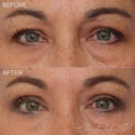 Before & After (id-1040) – Upper Eyelid Surgery