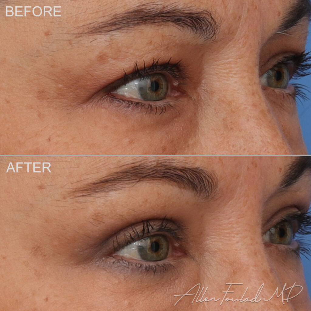 Before and after Upper Eyelid Surgery, on female patient.