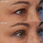 Before & After (id-1040) – Upper Eyelid Surgery