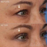 Before & After (id-1040) – Upper Eyelid Surgery