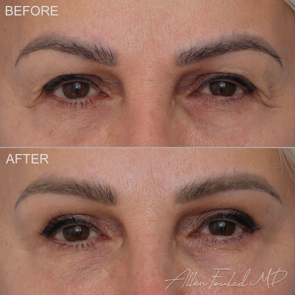 Before and after Upper Eyelid Surgery, on female patient.