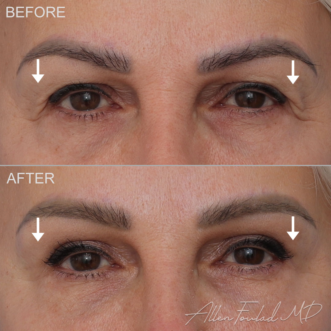 Before and after Upper Eyelid Surgery, on female patient.