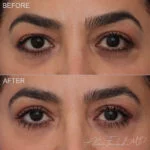 Before & After (id-1032) – Upper Eyelid Surgery