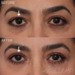 Before & After (id-1032) – Upper Eyelid Surgery