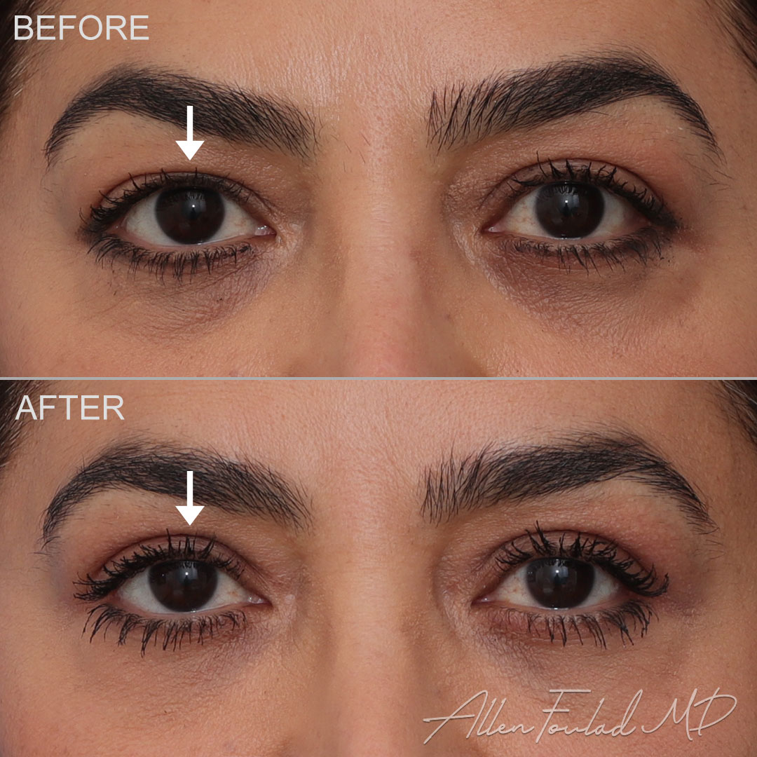 Before and after Upper Eyelid Surgery, on female patient.