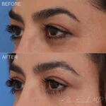 Before & After (id-1032) – Upper Eyelid Surgery