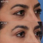 Before & After (id-1032) – Upper Eyelid Surgery