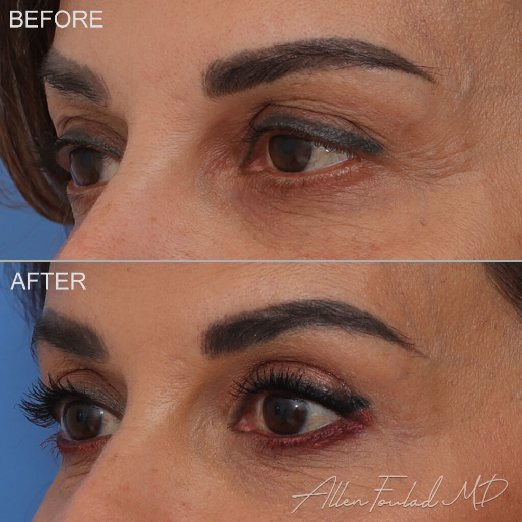 Before and after Upper Eyelid Surgery, on female patient.