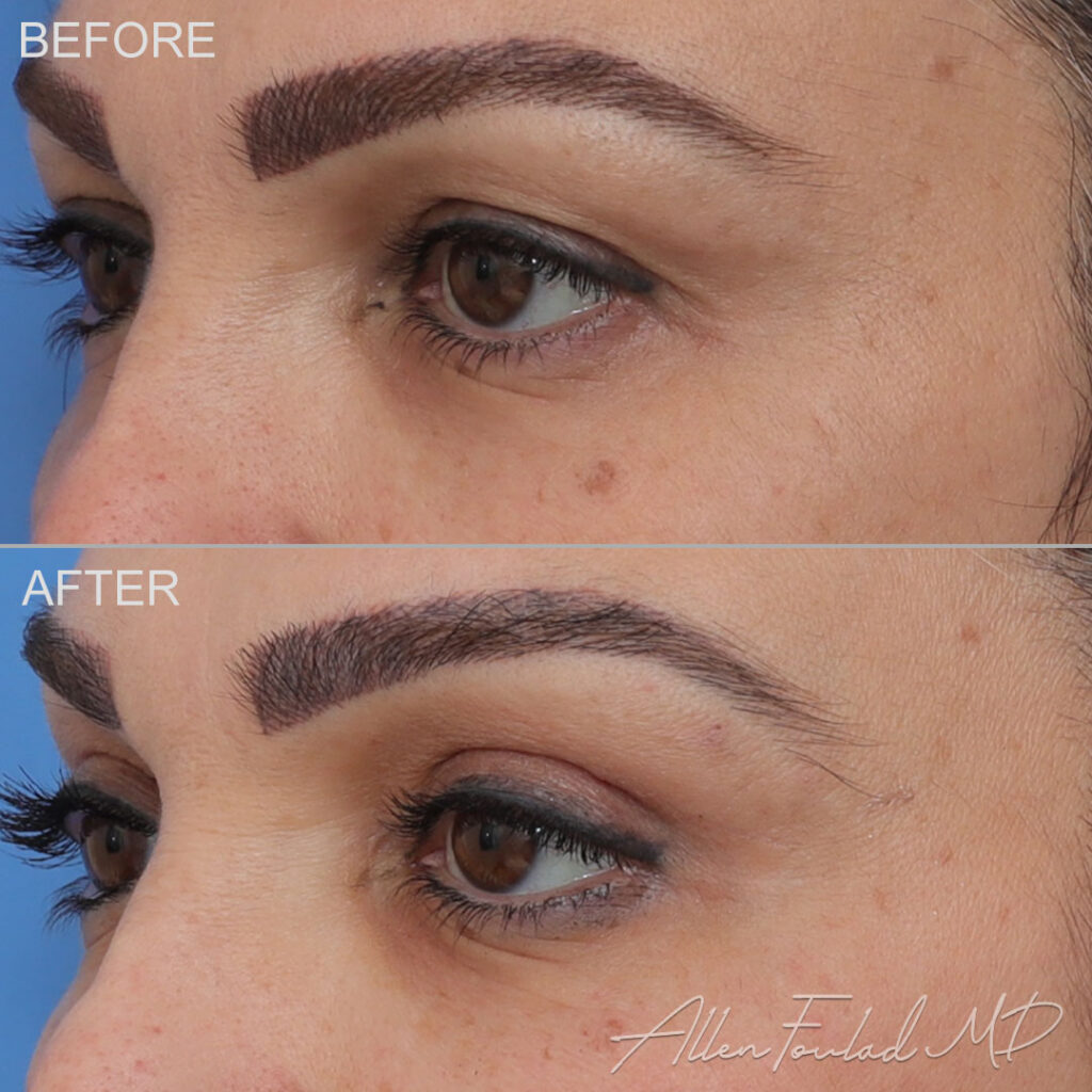 Before and after Upper Eyelid Surgery, on female patient.