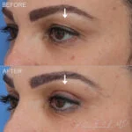 Before & After (id-1034) – Upper Eyelid Surgery