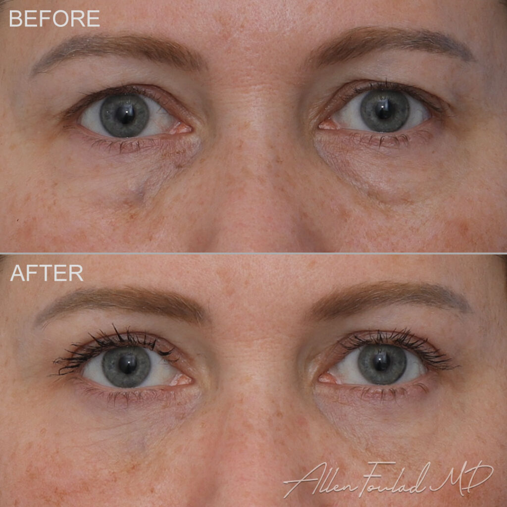 Before and after Upper Eyelid Surgery, on female patient.