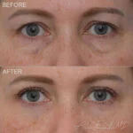 Before & After (id-1035) – Upper Eyelid Surgery