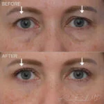 Before & After (id-1035) – Upper Eyelid Surgery