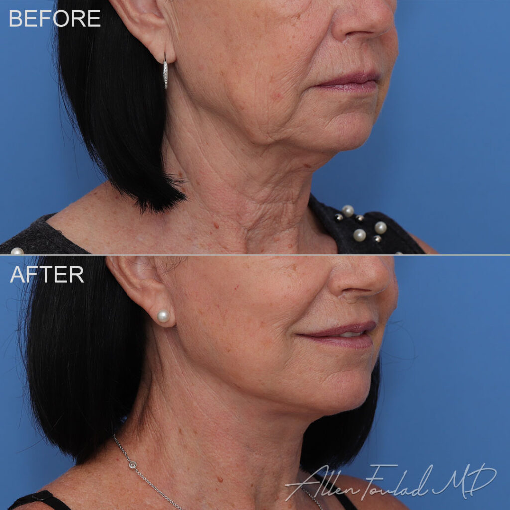 Before and after facelift and neck lift, on female patient.