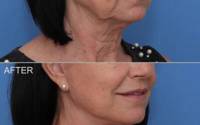 Case 1071