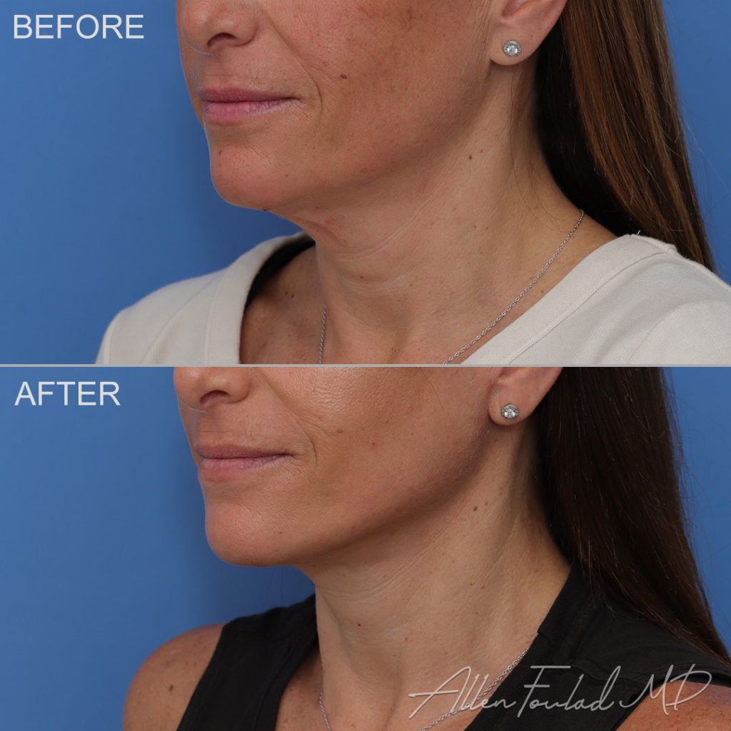 Before and after facelift and neck lift, female patient