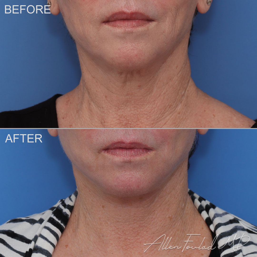 Before and after facelift and neck lift, on female patient