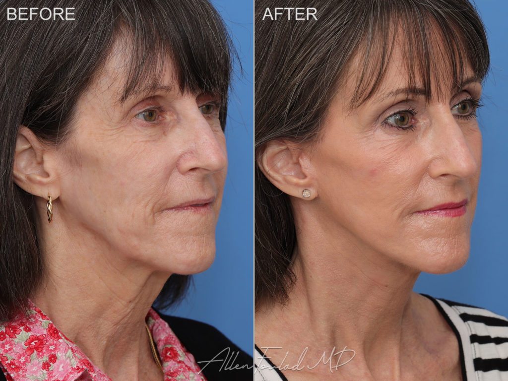 Before and after facelift and neck lift, on female patient.