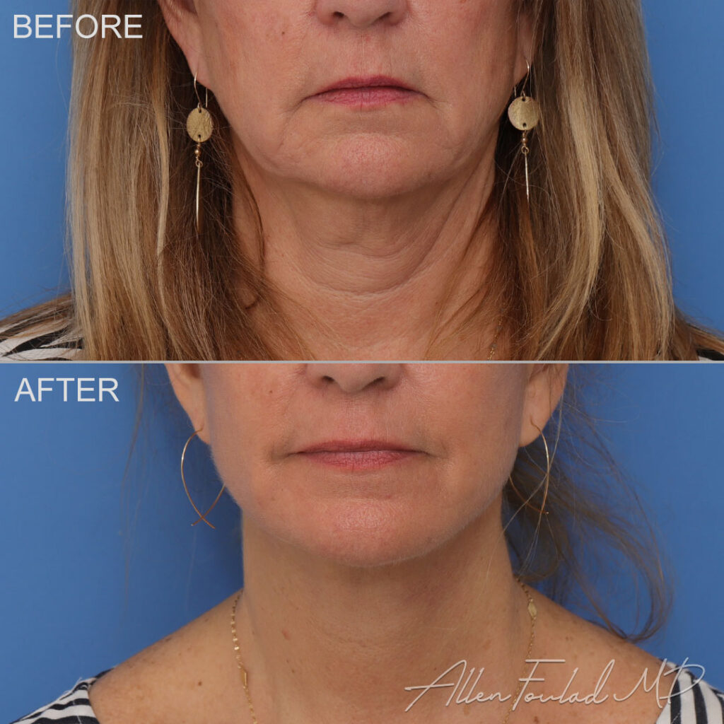 Before and after facelift and neck lift, on female patient.