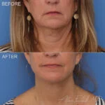 Before & After (id-1068) – Facelift and Neck Lift