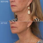 Before & After (id-1068) – Facelift and Neck Lift