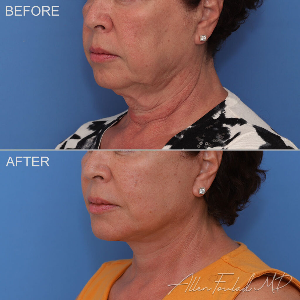 Before & After (id-1070) – Facelift and Neck Lift Before and after facelift and neck lift, on female patient.
