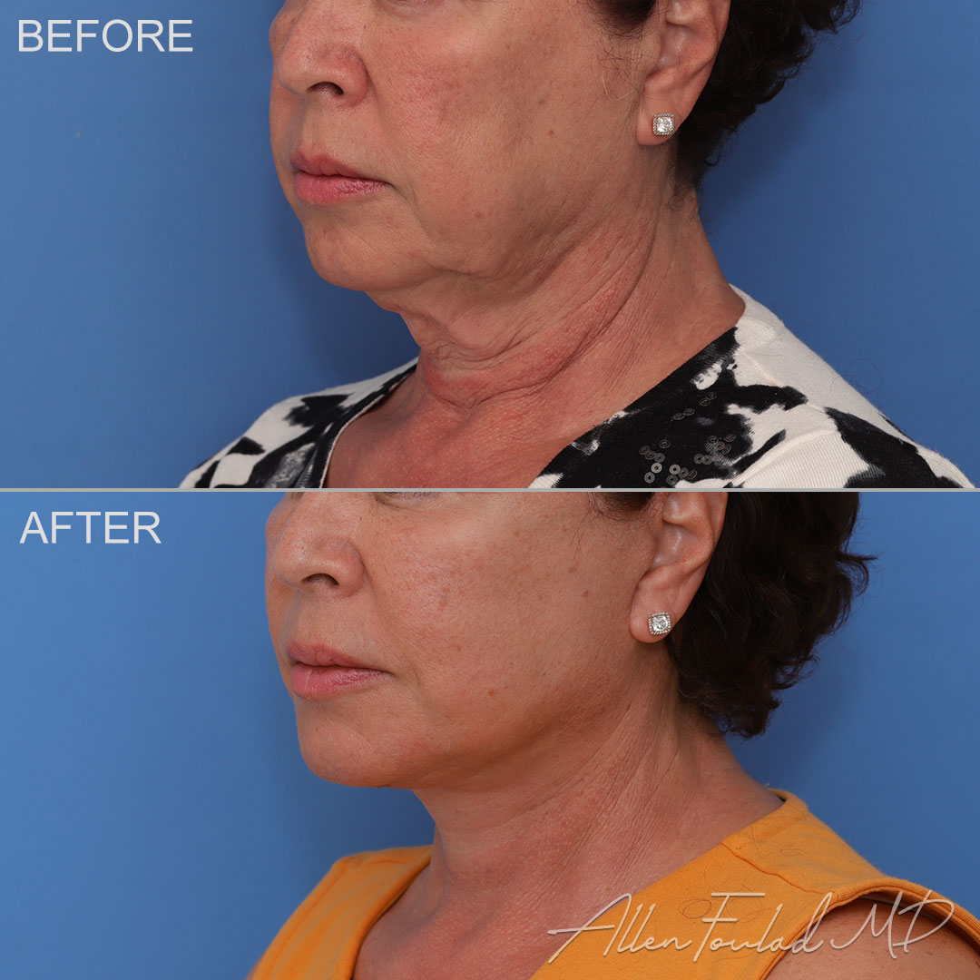 Before and after facelift and neck lift, on female patient.