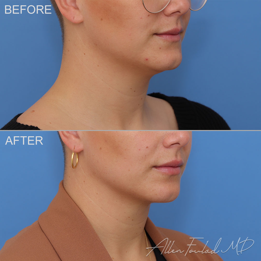 Before and after Liposuction of Face and Neck, on female patient.