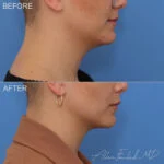 Before & After (id-1050) - Liposuction of Face and Neck