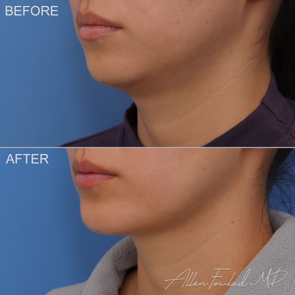 Before and after Liposuction of Face and Neck, on female patient.