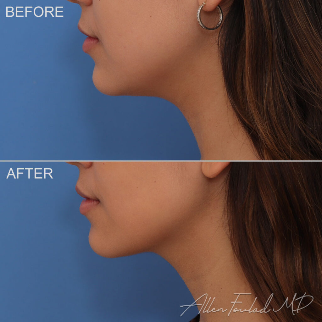 Before and after Liposuction of Face and Neck, on female patient.