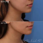 Before & After (id-1052) – Liposuction of Face and Neck